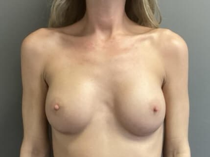 Anterior After