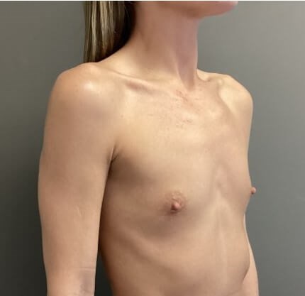 Oblique Before