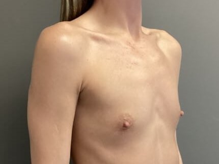 Oblique Before