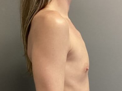 Side Before