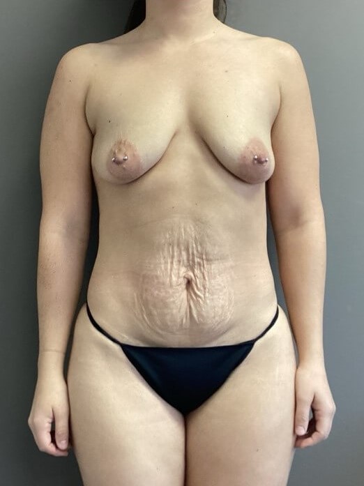 Anterior Before
