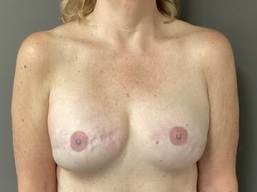 Anterior After