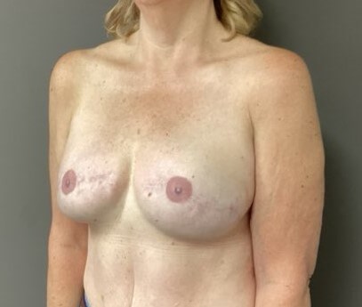 Oblique After