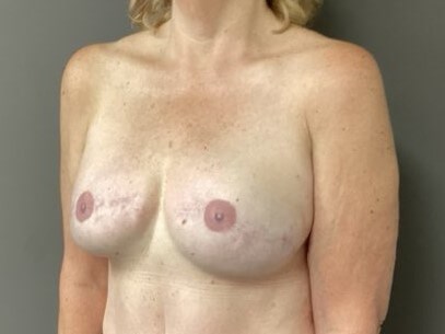 Oblique After