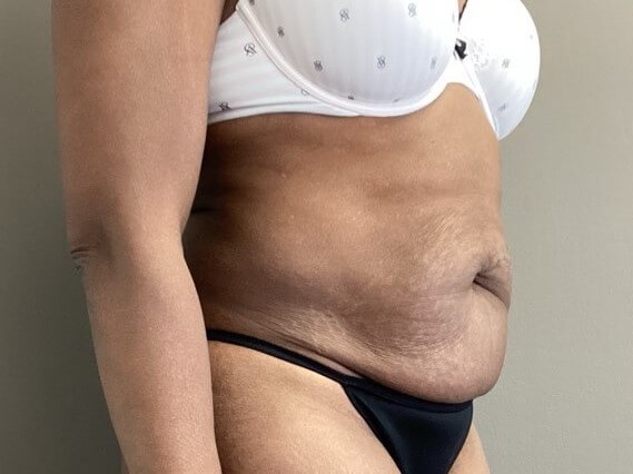 Oblique Before