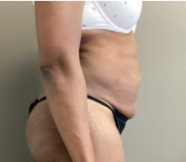 Lateral Before