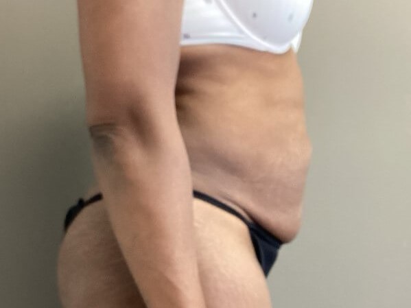 Lateral Before
