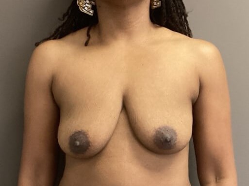 Anterior Before