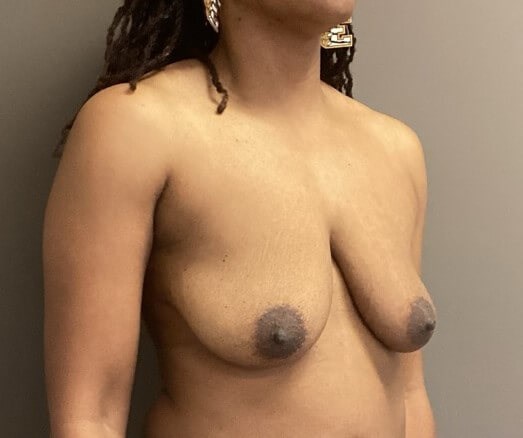 Oblique Before