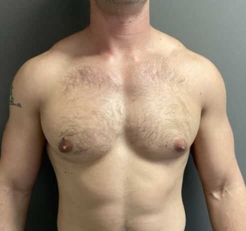 Anterior Before