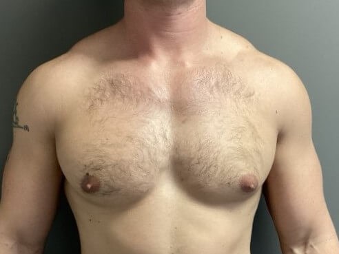 Anterior Before