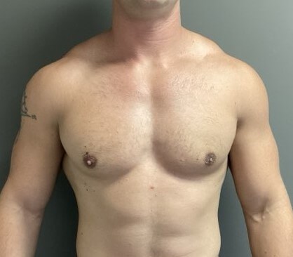 Anterior After