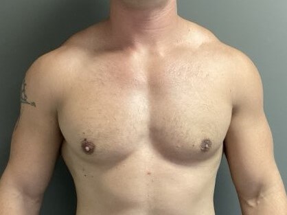 Anterior After