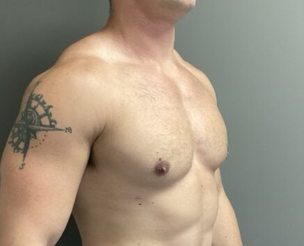Oblique After