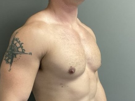 Oblique After
