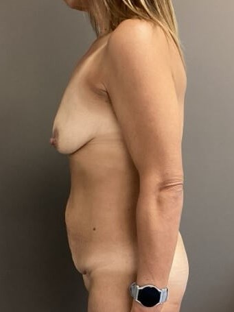 Side Before