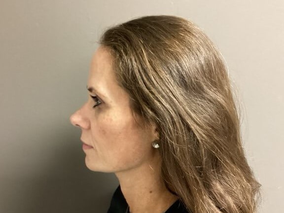 Side Before