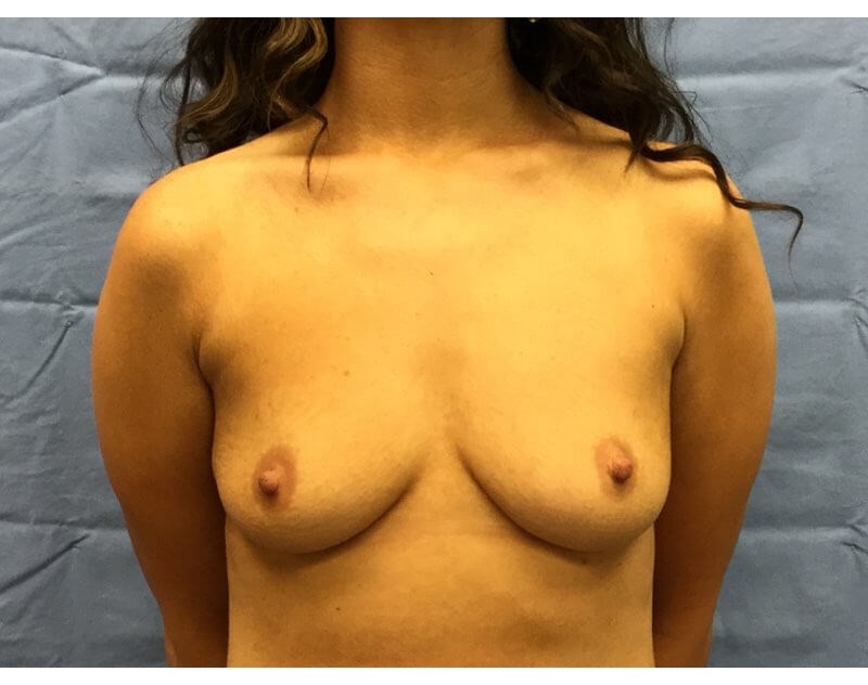 Anterior Before