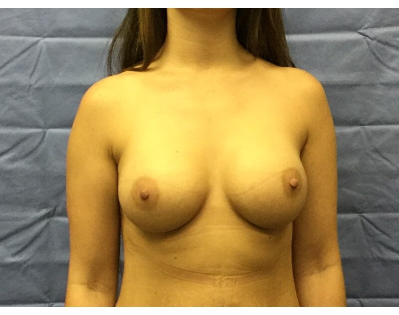 Anterior After