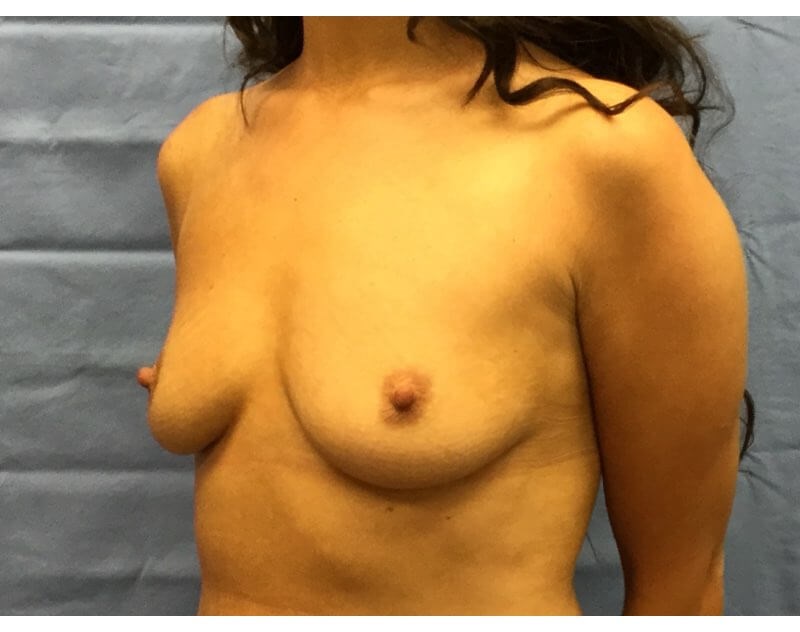 Oblique Before