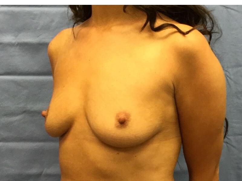 Oblique Before