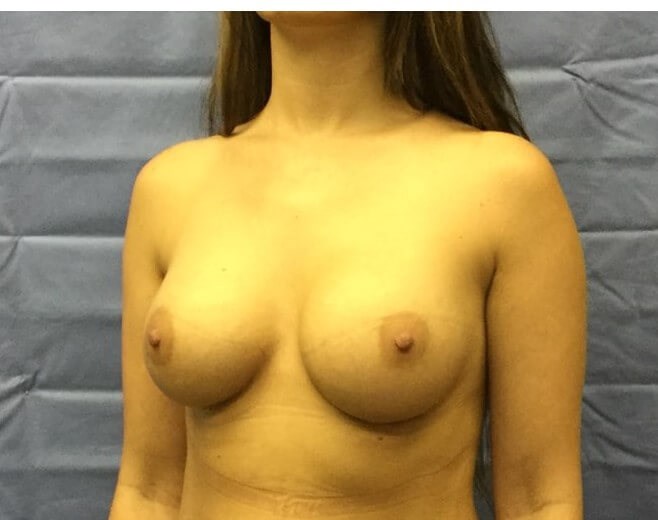 Oblique After