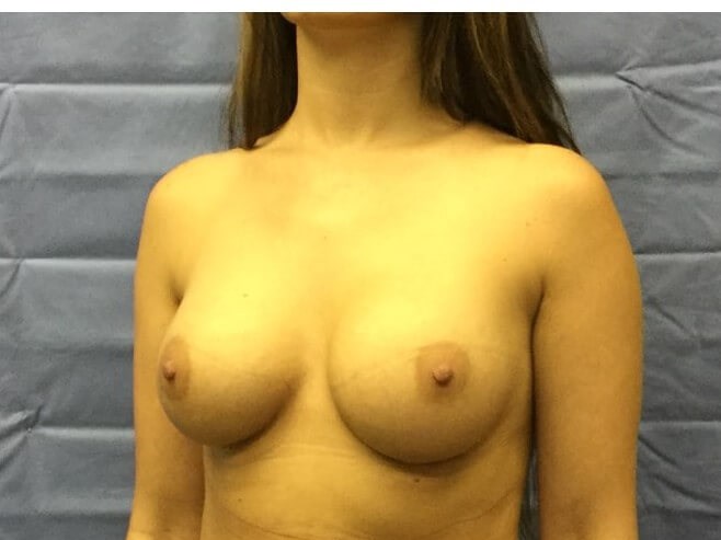 Oblique After