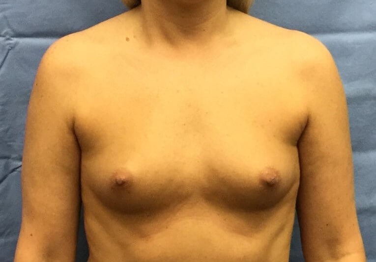 Anterior Before
