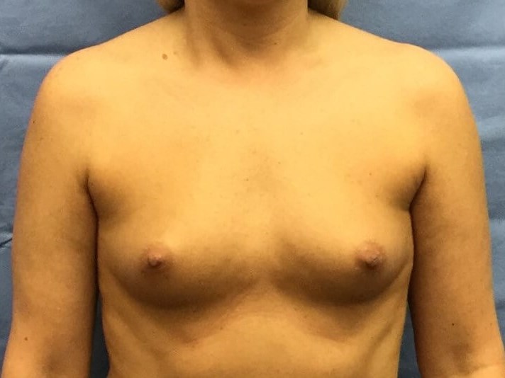 Anterior Before