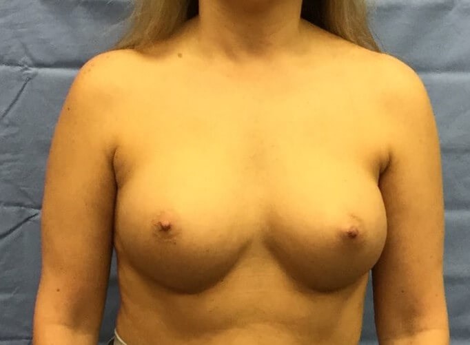 Anterior After
