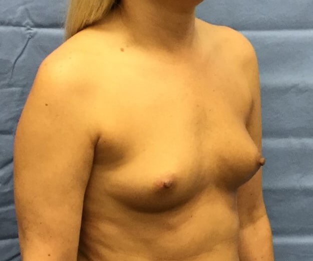 Oblique Before