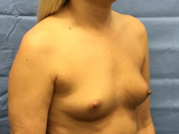 Oblique Before