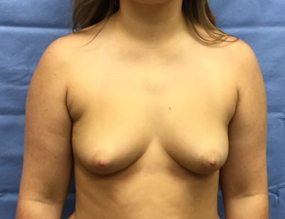 Anterior Before