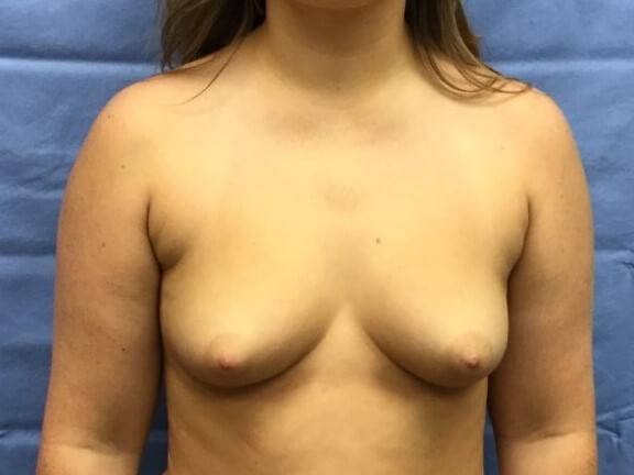 Anterior Before