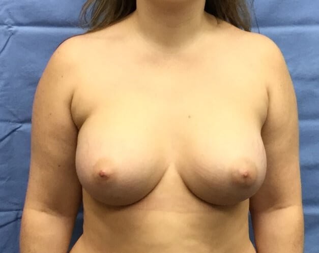 Anterior After