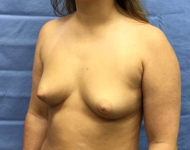 Oblique Before
