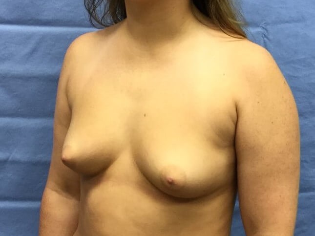 Oblique Before