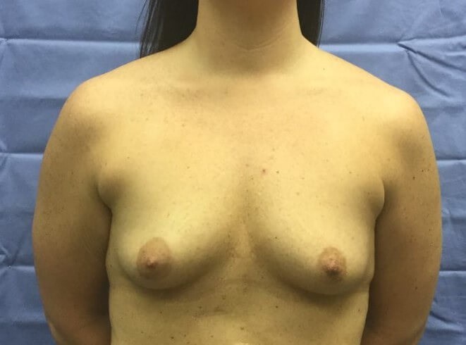 Anterior Before