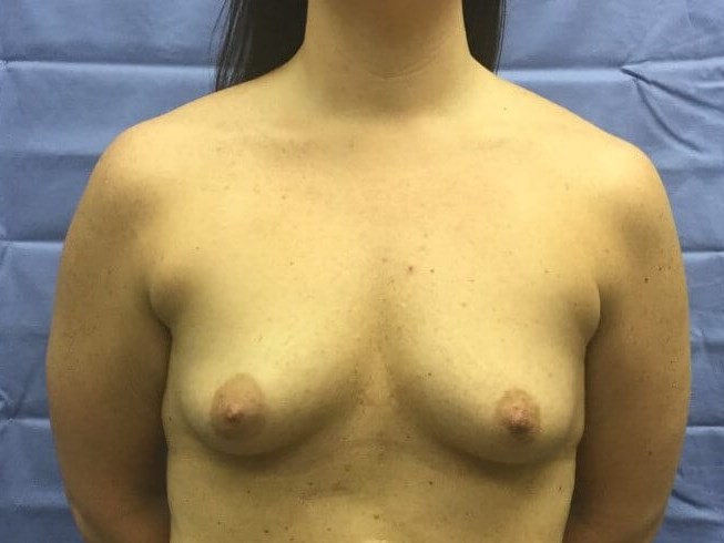 Anterior Before