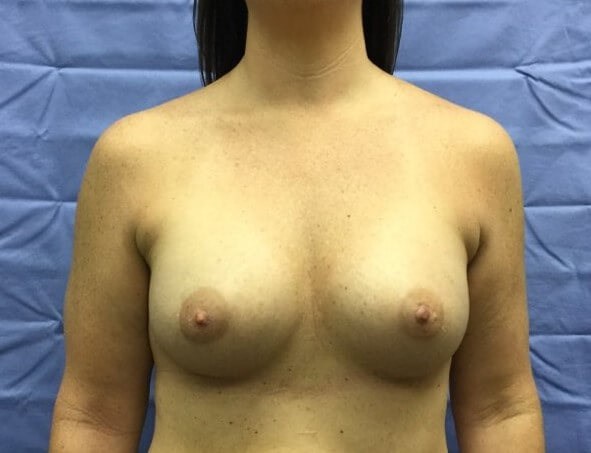 Anterior After