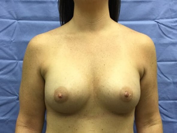 Anterior After