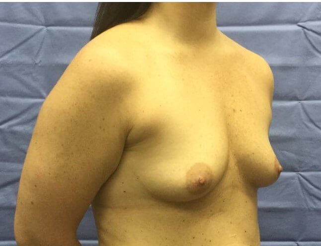 Oblique Before