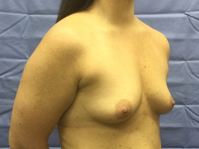 Oblique Before