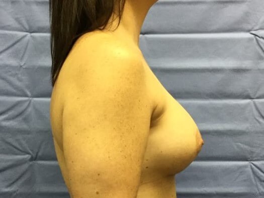 Side After