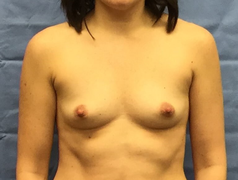 Anterior Before