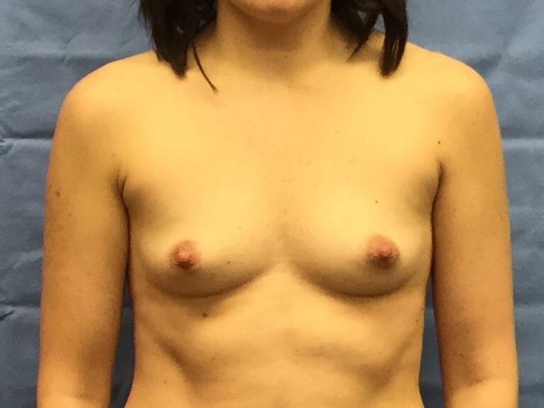Anterior Before