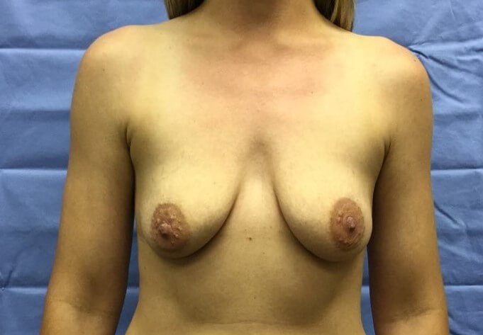 Anterior Before