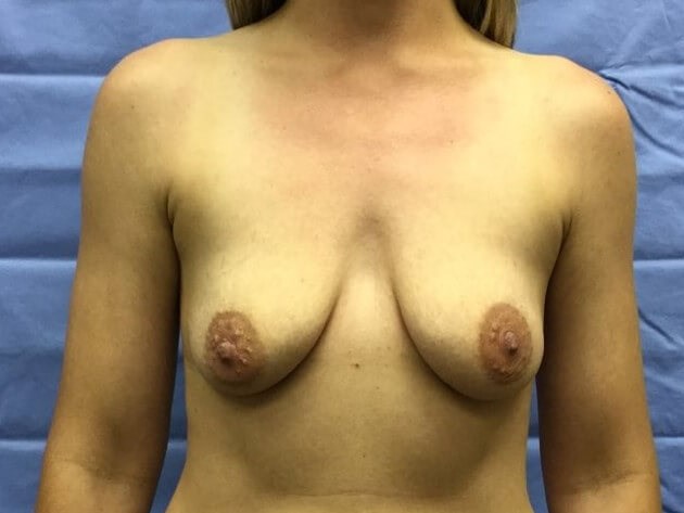Anterior Before