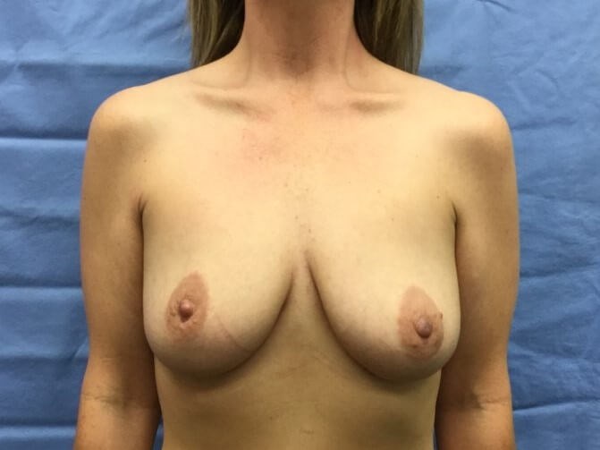 Anterior Before