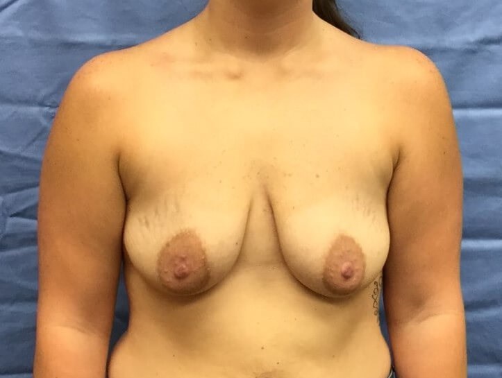 Anterior Before